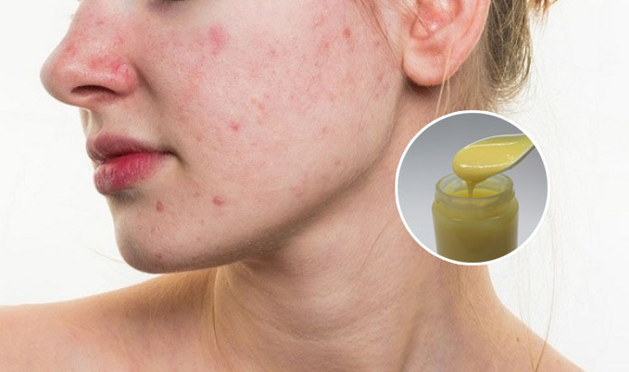 Biểu Hiện, Cách Chữa Dị Ứng Sữa Ong Chúa - Phải Làm Sao?