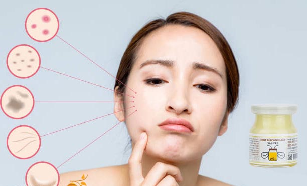 Mặt Nạ Sữa Ong Chúa Trị Mụn Thâm, Liệu Có An Toàn?