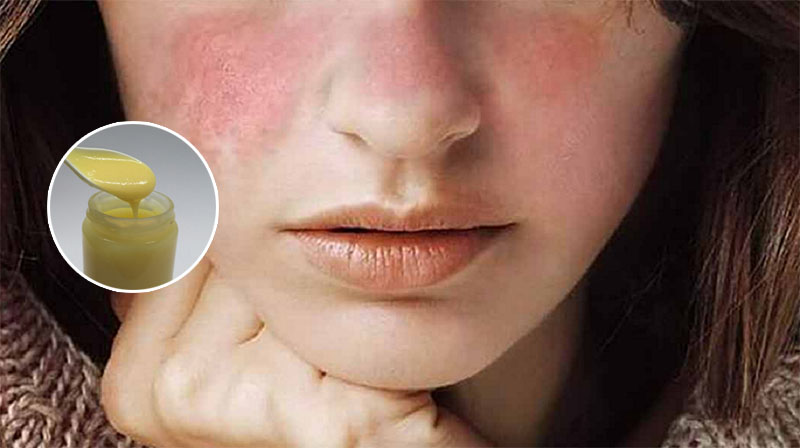 Sữa Ong Chúa Đắp Mặt Bị Rát