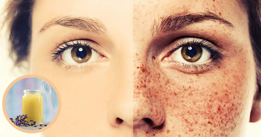 Sữa Ong Chúa Trị Tàn Nhang