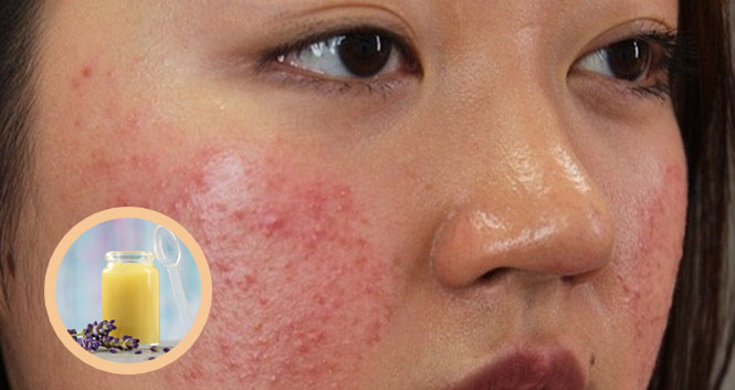 Uống Sữa Ong Chúa Bị Nổi Mụn