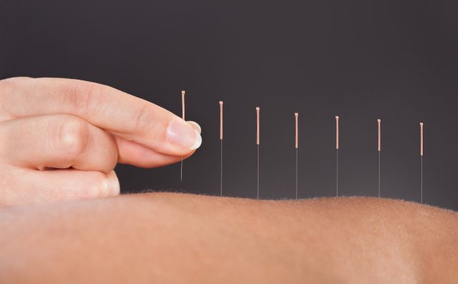 10 lợi ích sức khỏe của châm cứu không phải ai cũng biết