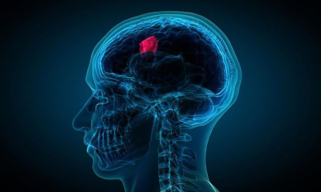 dấu hiệu cảnh báo bệnh u não mà nhiều người không biết