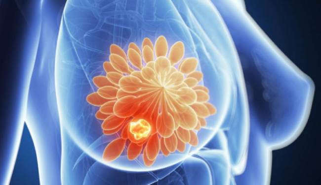 dấu hiệu và triệu chứng của ung thư vú