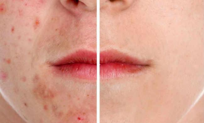 nguyên nhân, triệu chứng và cách điều trị mụn trứng cá