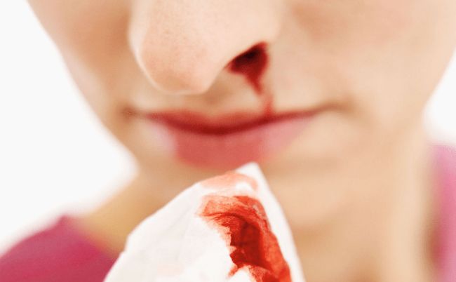 nguyên nhân, cách xử lý và phòng ngừa chảy máu cam