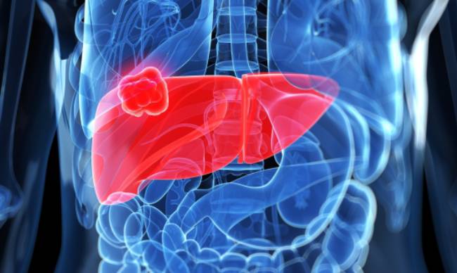 những triệu chứng của ung thư gan thường bị bỏ qua