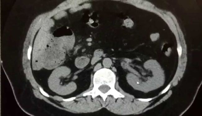 hình ảnh chụp cắt lớp vi tính (CT) tiết niệu